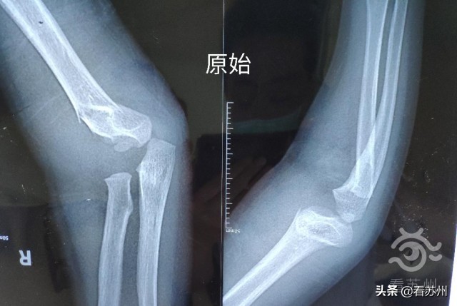 小女孩骨折神奇复位视频,骨折女孩正骨复位