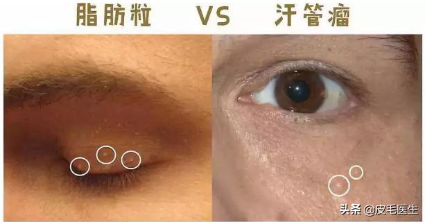 眼霜变颗粒了还能用吗,为什么用了眼霜眼周围会有颗粒