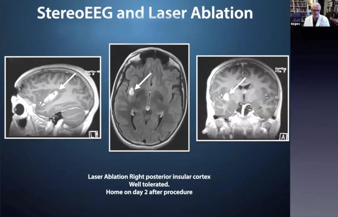 儿童癫痫治愈的真实案例,儿童难治性癫痫有哪些