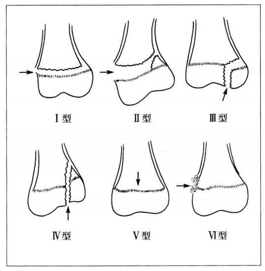 小孩腿部骨折后对身高有影响么,孩子骨折会影响身高吗
