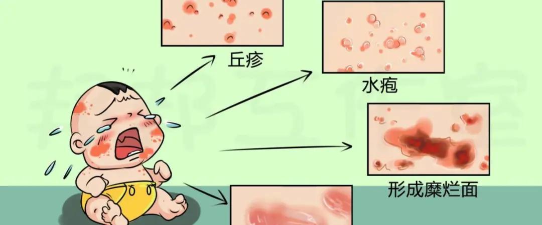 宝宝湿疹总不好怎么回事,宝宝湿疹一直不好是怎么回事