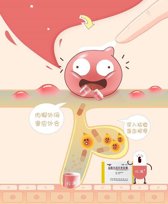 痘痘严重爆发，口服抗生素治疗安全有效吗？