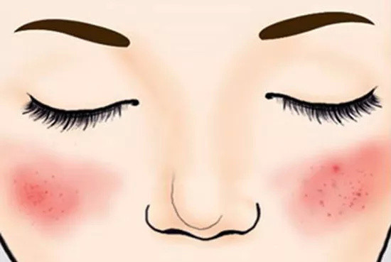 混合性结缔组织病是罕见病吗,难以治愈和捉摸不透的骨关节炎