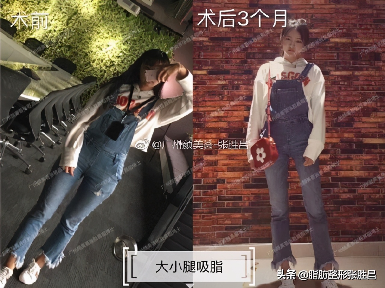 想瘦哪就瘦哪？抽脂才没那么神奇，变美要安全，请别再过度医疗了