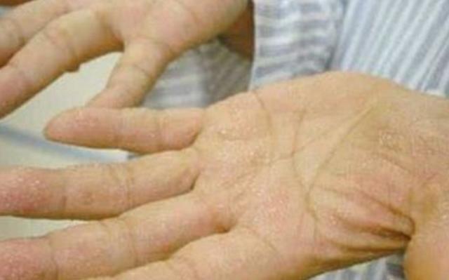 为了避免手上起水泡该怎么预防,一到天热手上起水泡脱皮