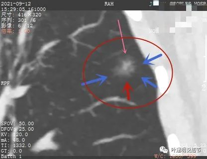 从活检怎么看是非小细胞癌,从病例谈辨证论治