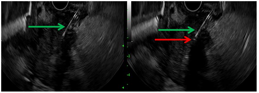 高能超声在晚期胰腺癌中的应用,内镜光动力治疗