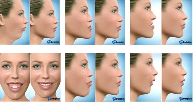 骨性龅牙做正畸还是正颌,骨性龅牙正颌手术前要正畸吗