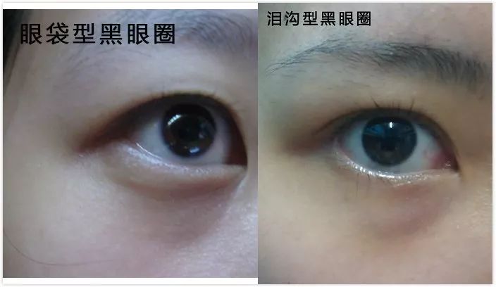 没有熬夜却有黑眼圈怎么消除,没熬夜的黑眼圈怎么去除