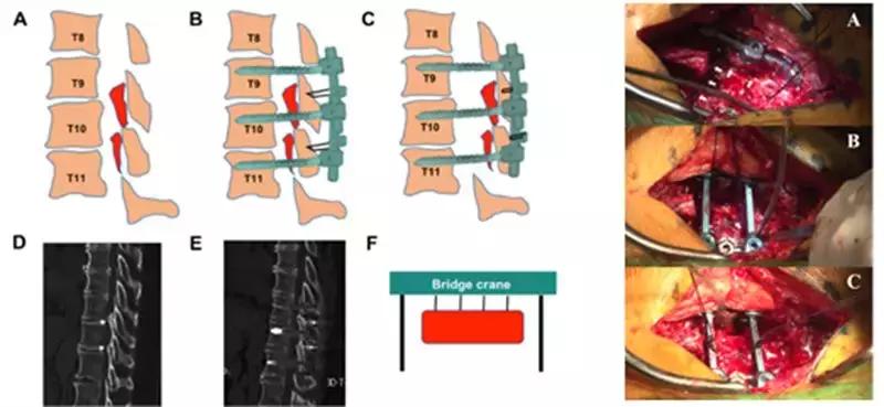 胸椎黄韧带骨化的治疗方法,胸椎黄韧带骨化症手术效果如何
