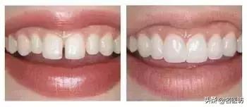 牙齿缝隙越来越大和智齿有关吗,牙齿缝隙越来越大能矫正吗