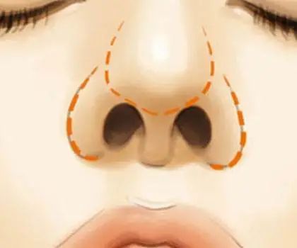 鼻子宽怎么变小一点,鼻子又宽又大怎么变小