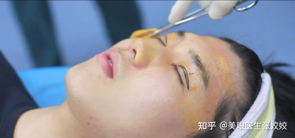 男生双眼皮手术前后对比,男生做双眼皮手术的效果