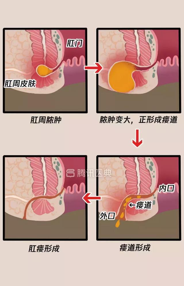 “*菊爆**后”痛到喊妈!真实看病经历泣血奉上,必须保护好菊花