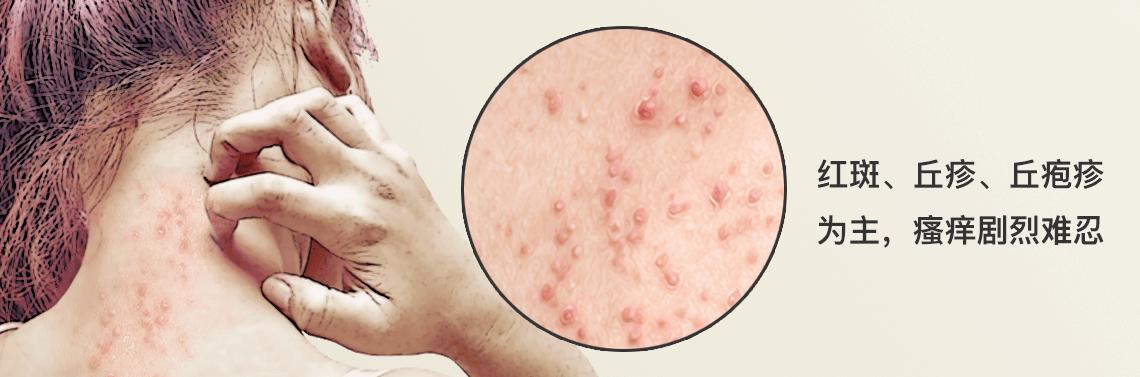 治疗皮肤湿疹的外涂药物有哪些,有湿疹增强免疫力的药物有哪些