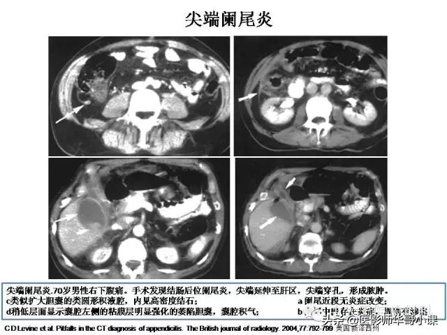 阑尾炎课件,阑尾炎的超声课件