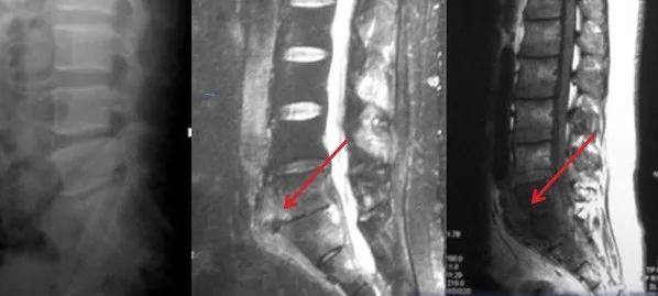 脊柱结核保守治疗大约需要多少钱,脊柱结核可以保守治疗