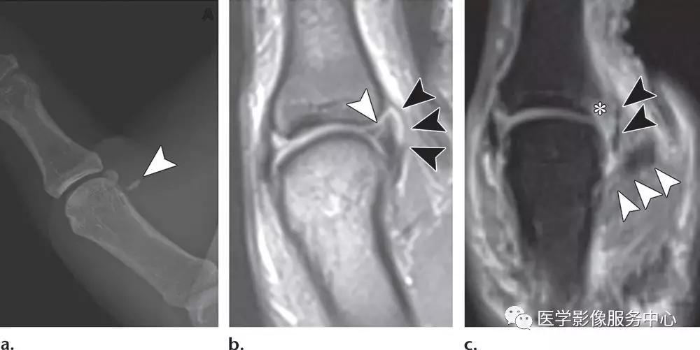 手腕撕脱性骨折一年了还隐隐作痛,手腕三角骨撕脱骨折症状有哪些
