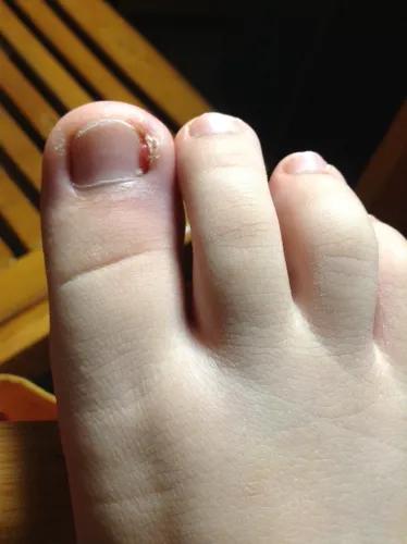 儿童怎么预防甲沟炎,美甲能预防甲沟炎吗