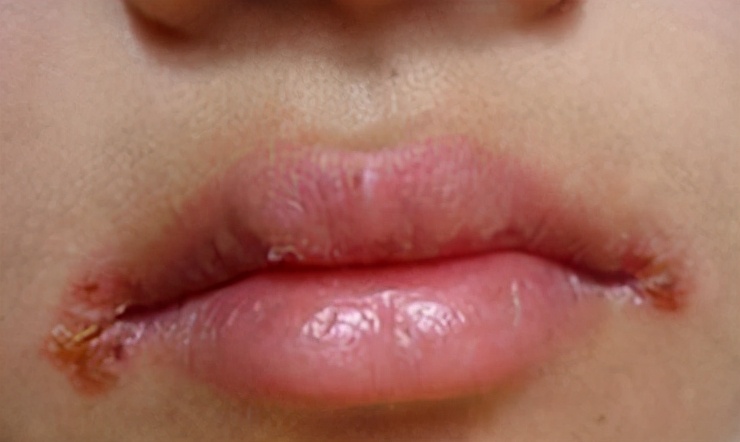 小孩上火烂嘴角最快治疗方法,因上火而烂嘴角吃什么药好呢