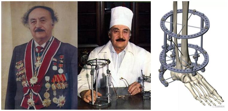 太原中心医院骨科汾东一病区完成首例ilizarov外固定矫形高弓足