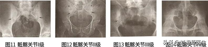 怀孕如何避免强直性脊柱炎,免疫修复治强直性脊柱炎