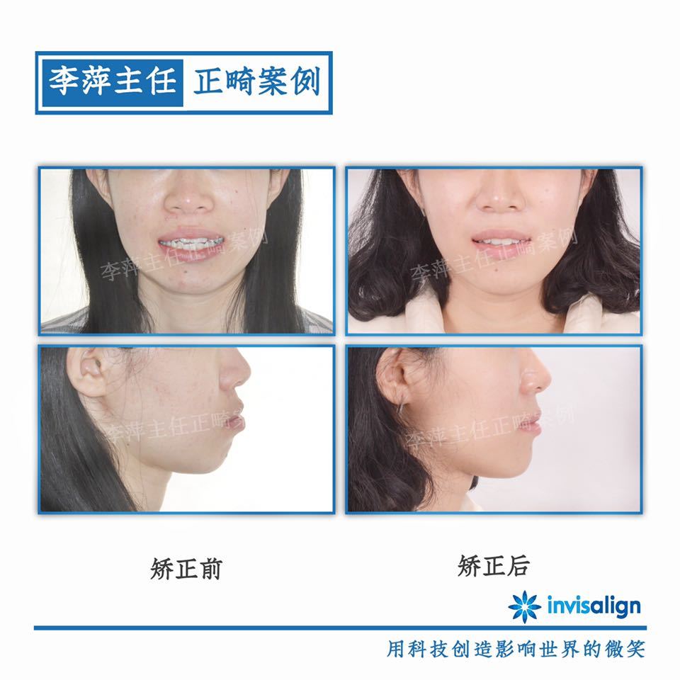 深覆合牙齿不齐矫正案例,29岁牙齿矫正龅牙前突案例
