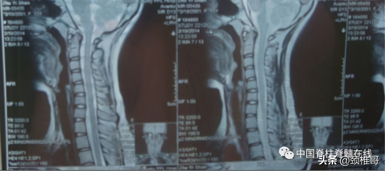 颈椎病的护理临床路径流程图,颈椎病的健康管理与康复指导