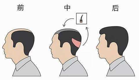 有了这个神器，英国人的脱发有救了？