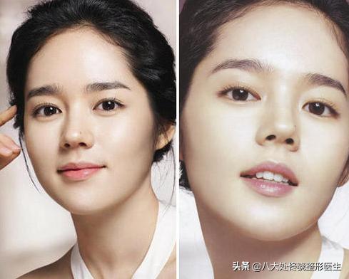 面部一枝花全靠鼻子当家,鼻子一针玻尿酸效果图