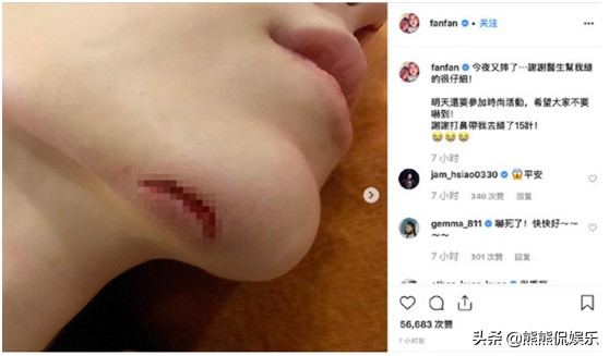 范玮琪不慎摔伤，下把六厘米伤口缝15针，伤口深可见骨