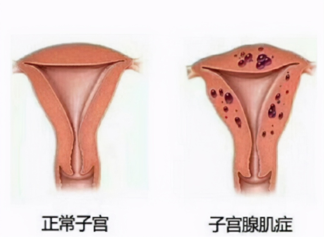 了解子宫疾病，看这一篇就够了