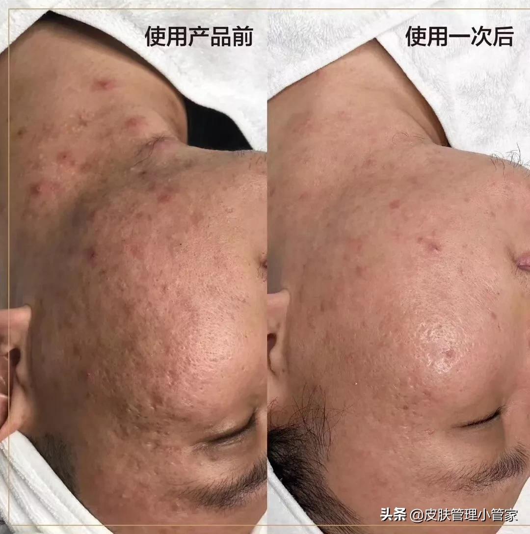 脸上痘坑黑头严重皮肤暗沉,脸有痘坑痘印毛孔大黑头怎么办