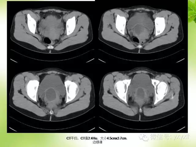 苗勒氏管囊肿在哪里,苗勒氏管囊肿是指什么