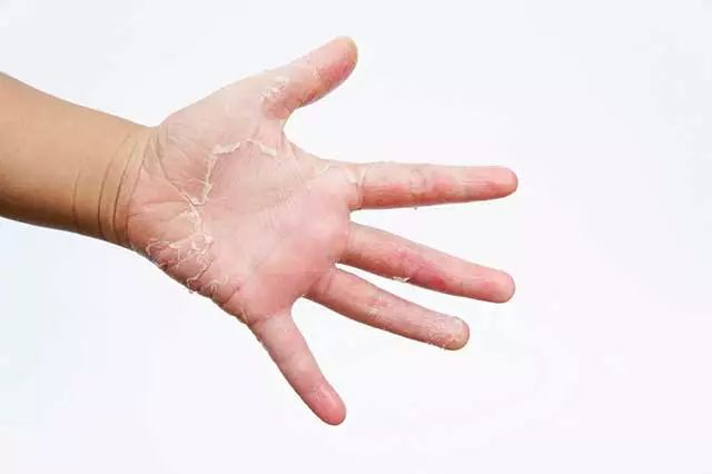 夏天手上长痘痒是怎么回事,夏天手上起小水泡发痒怎么回事