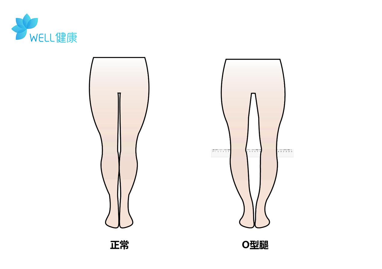 o型腿很丑怎么办,o型腿除了难看还有啥