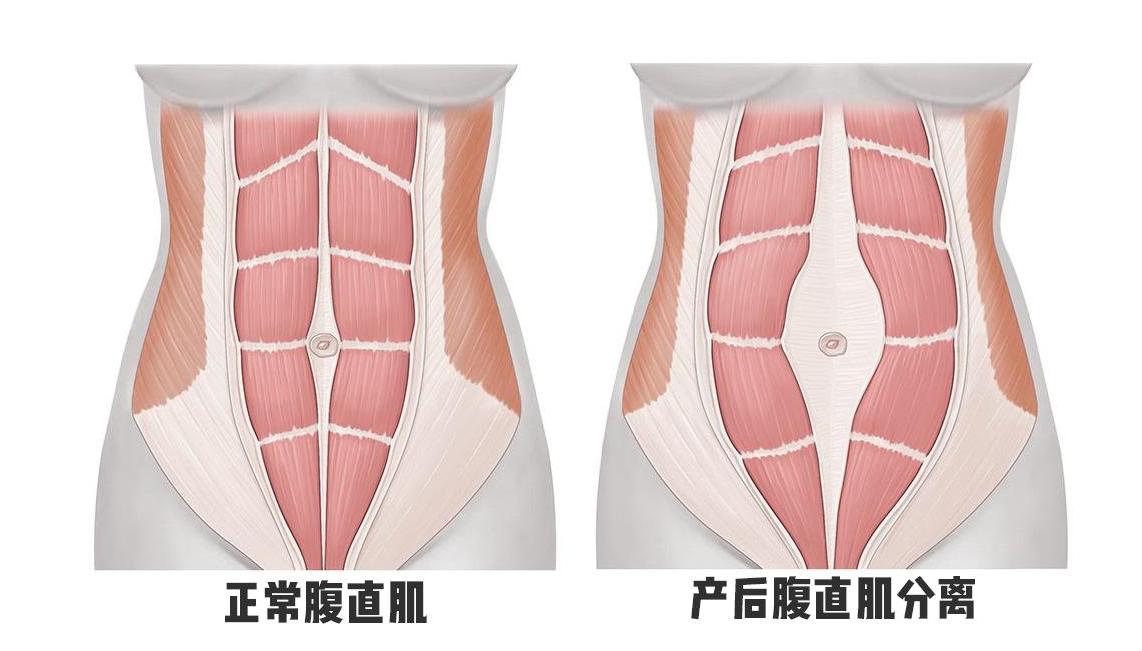 送给产假结束的老婆，按摩塑形+暖宫的斐洛腰部按摩仪