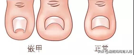 孩子脚趾红肿怎么回事不是甲沟炎,儿童脚趾甲甲沟炎红肿疼怎么处理