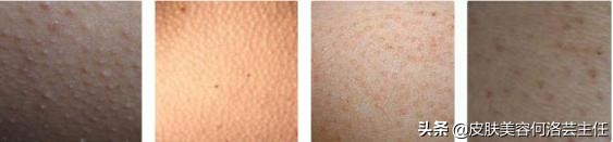 摆脱鸡皮肤的困扰,去鸡皮肤有效的方法真实测评