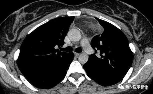前上纵隔高密度影考虑胸腺未退化,肺纵隔胸腺结节12mm看什么科