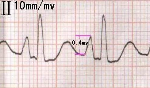 常见20种异常心电图及处理,常见20种异常心电图及特点