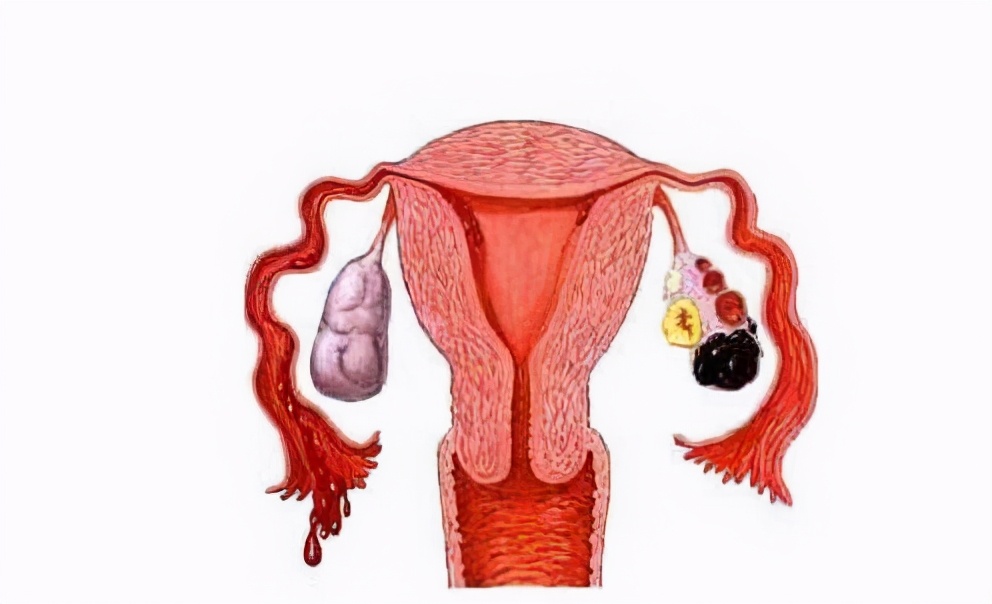 巧克力囊肿的原因和治疗方法,巧克力囊肿的最佳治疗方法