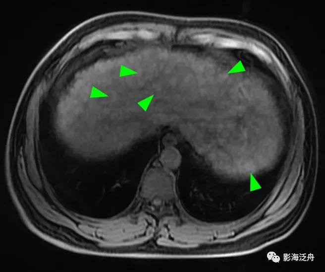 肝脏弥漫性病变严重吗,肝脏弥漫性的病变的症状