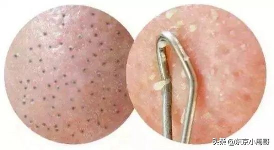 改善毛孔粗大的护肤习惯,可以改善毛孔粗大的护肤方法