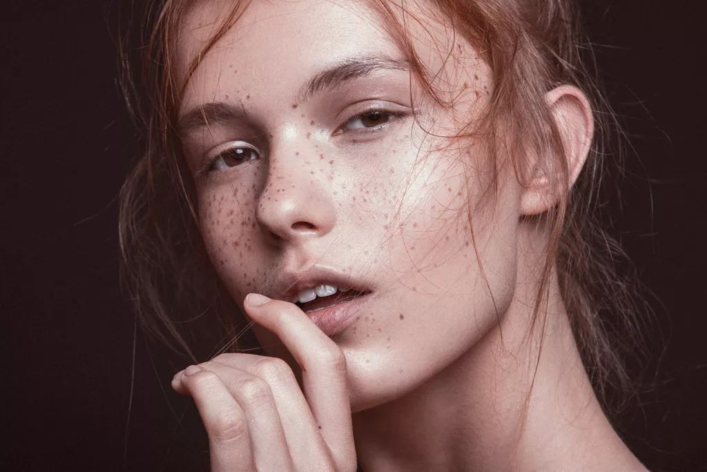 超皮秒激光祛斑真的有效果吗,超皮秒祛斑效果