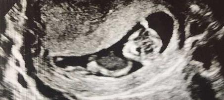 特殊的胎记前世事例,世上最独特的胎记