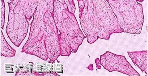 乳房肿块和纤维腺瘤,乳腺纤维腺瘤肿块有无血流信号