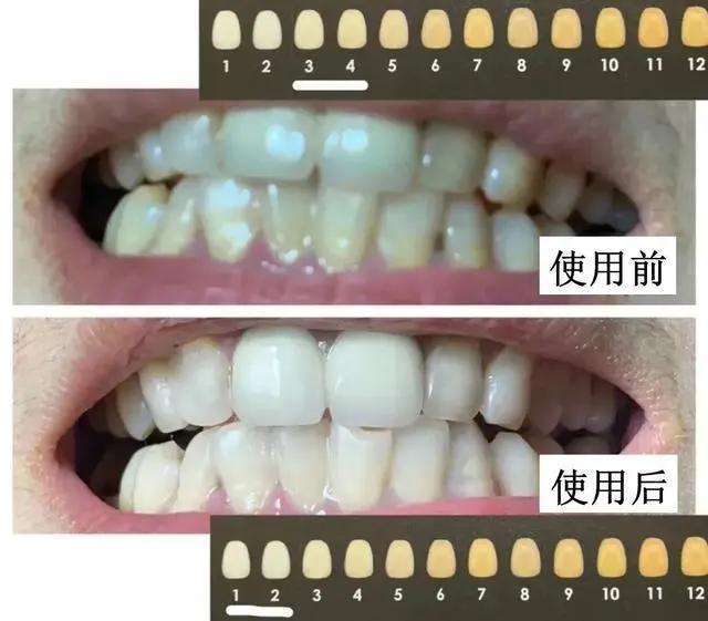 一张嘴臭牙齿就臭怎么办,一张嘴就口臭小妙招