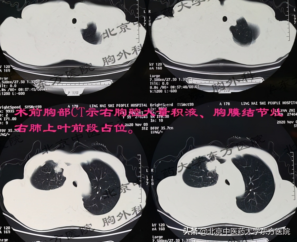 北京治疗胸腔积液哪个医院权威,中医治疗心脏胸腔积液