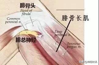 病理脚麻的最快恢复方法,脚麻诊断思路